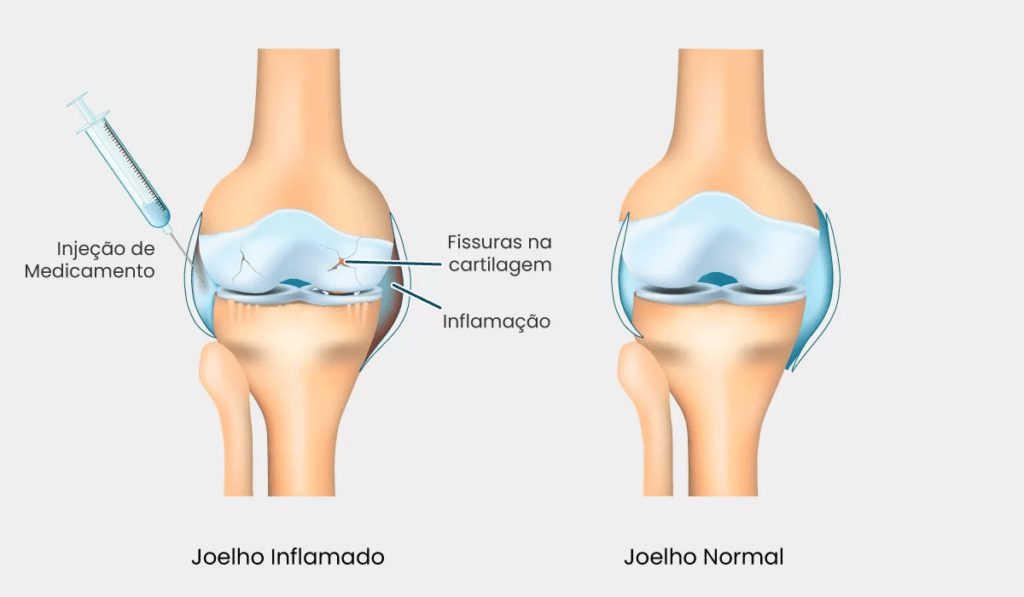 Infiltração articular no joelho