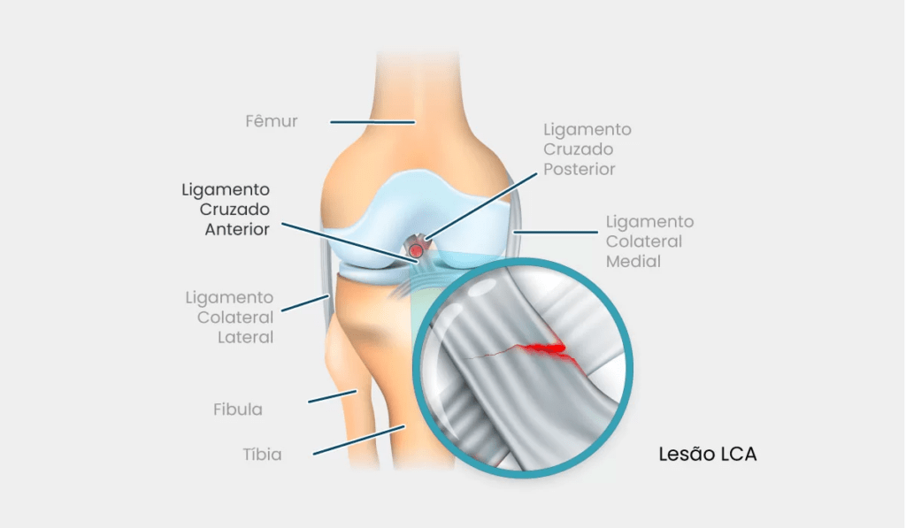 Ruptura do ligamento cruzado anterior (LCA)