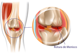 Lesão de menisco