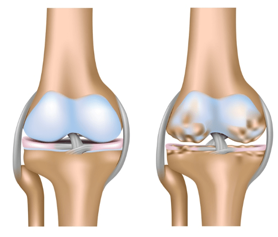 Artrose no joelho